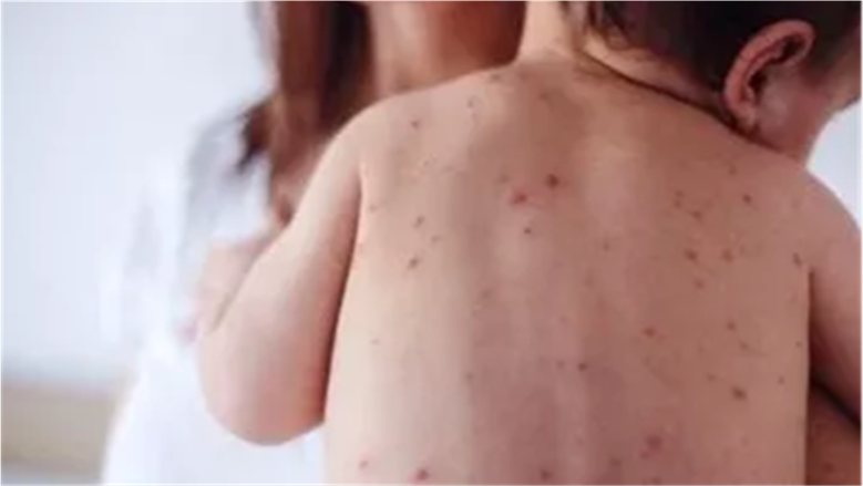 الهلال الأحمر يحذر من الاستهانة بالحصبة: مش مجرد حرارة وطفح جلدي