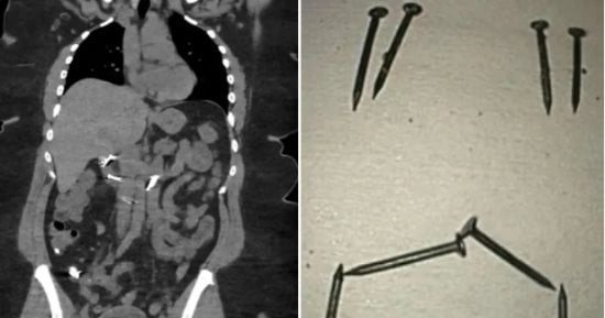 بسبب معاناتها من اضطراب بيكا.. استخراج 8 مسامير كبيرة من أمعاء بريطانية